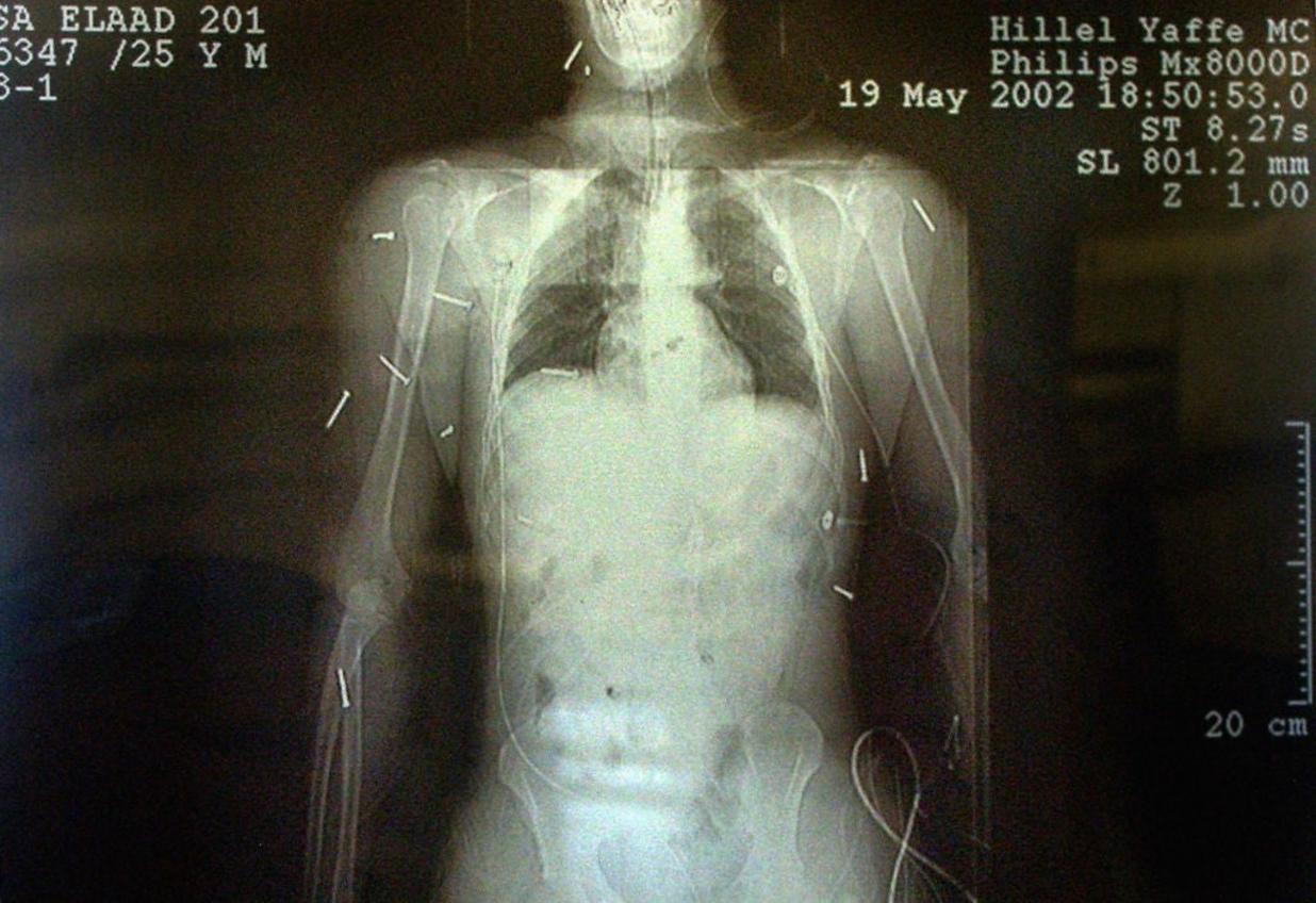 Radiografía mostrando el torso humano