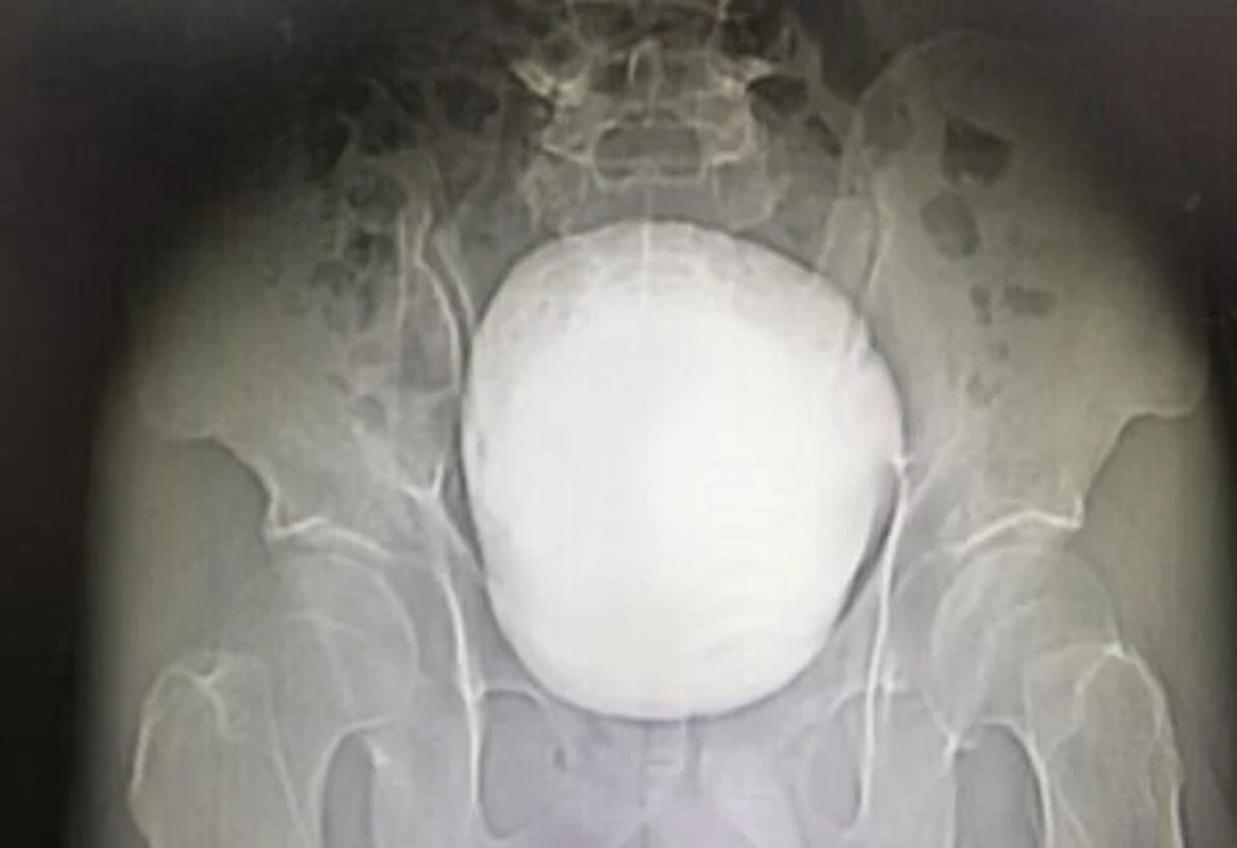Piedra gigante extraída de la vejiga del paciente