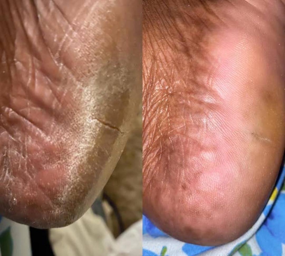 Talones agrietados antes y después de usar el gel