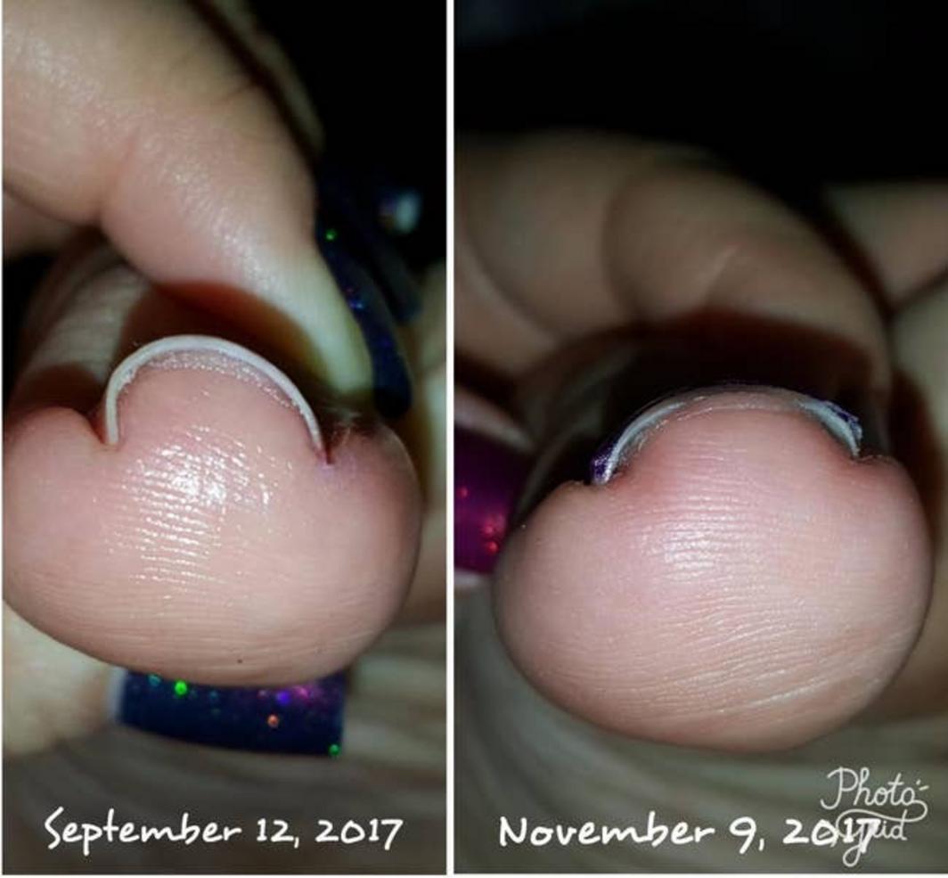 Antes y después del corrector de uñas encarnadas