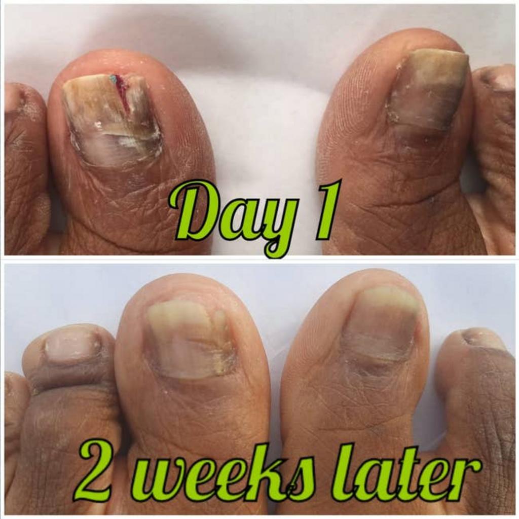 Antes y después de uñas con hongos